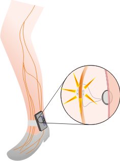 Urgent-SQ - Treatment for urge incontinence